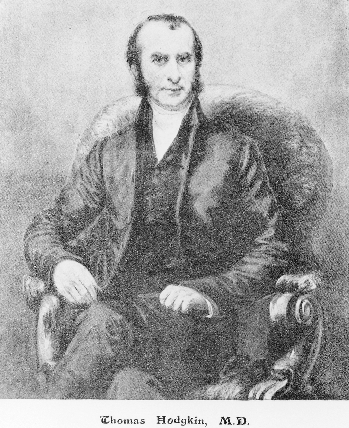 Linfoma di Hodgkin - Thomas Hodgkin